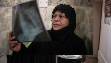 العراق: علاج مرضى السل المقاوم للأدوية المتعددة مريضًا تلو الآخر