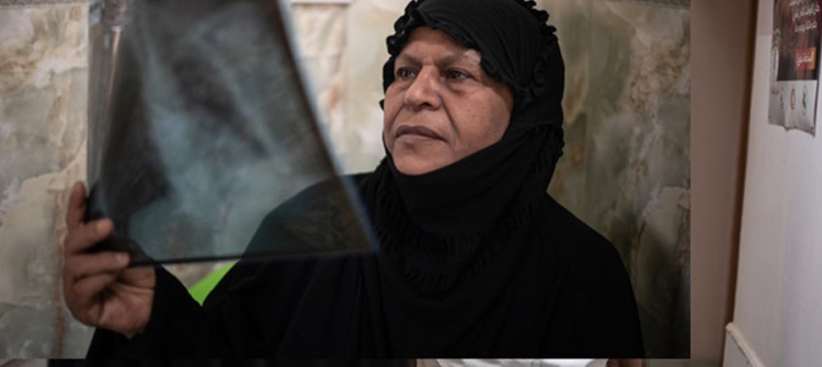 العراق: علاج مرضى السل المقاوم للأدوية المتعددة مريضًا تلو الآخر